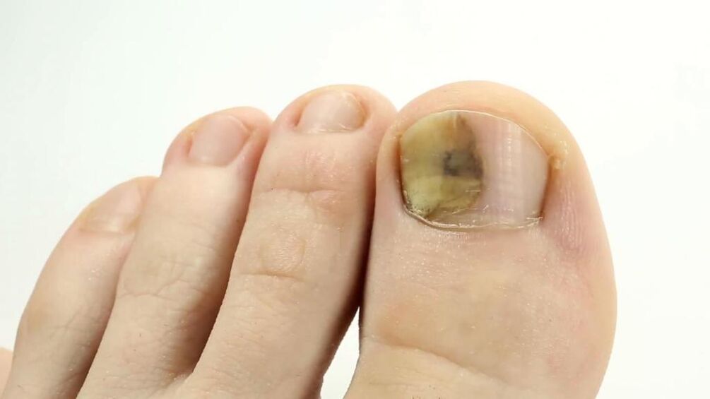 The appearance of a toenail affected by fungi